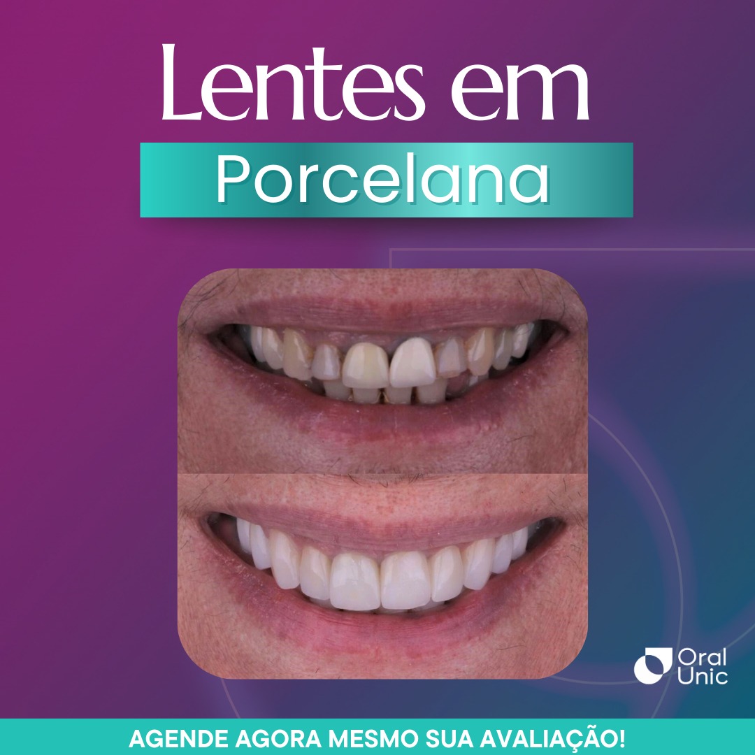 lentes em porcelana