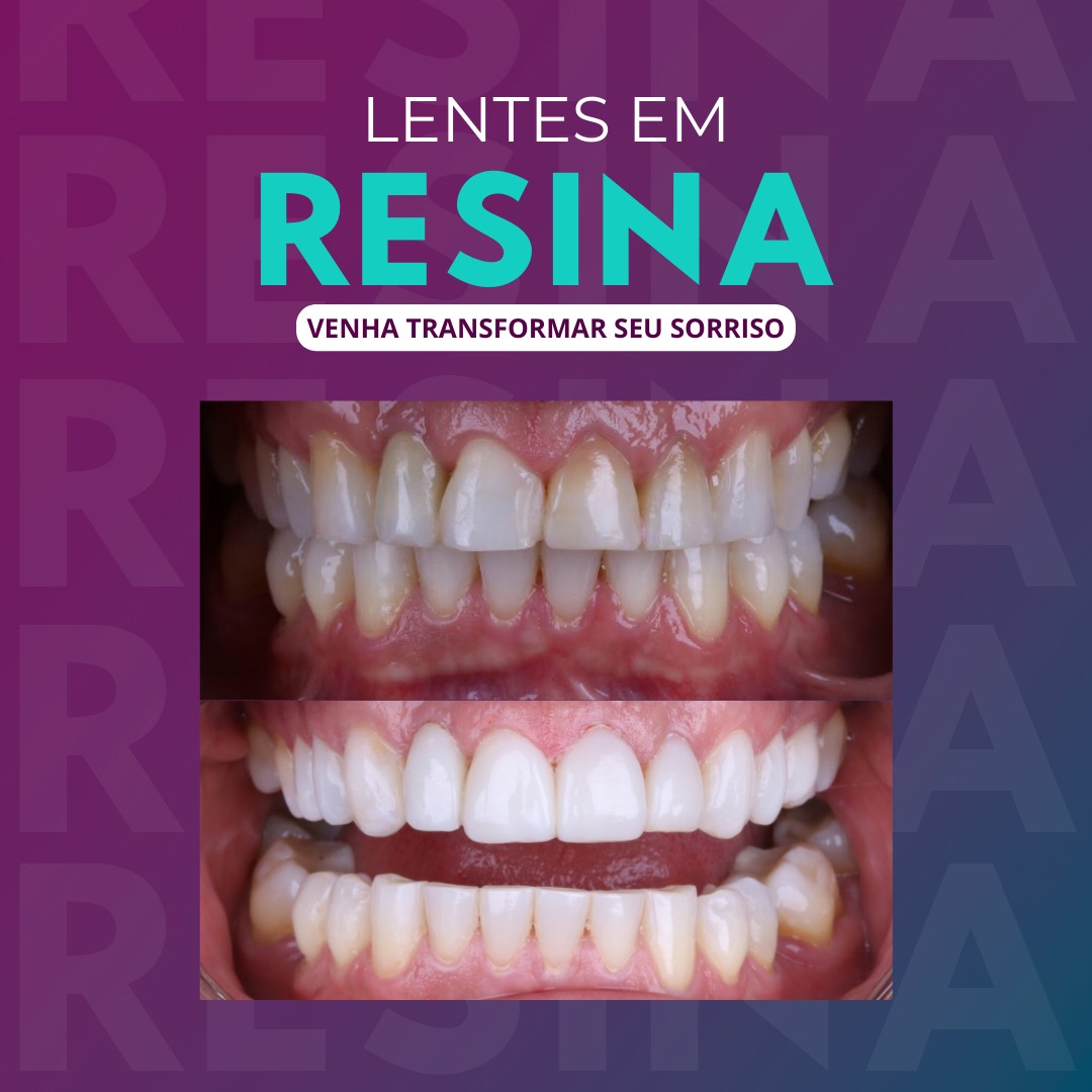 lentes em resina